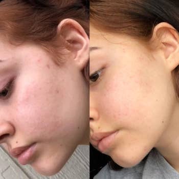 Before and after comparison of a person's skin, possibly demonstrating the effects of a skincare product