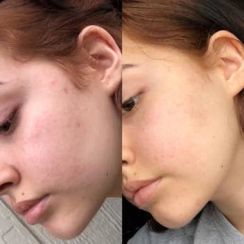Before and aft  examination  of a person's skin, perchance  demonstrating the effects of a skincare product