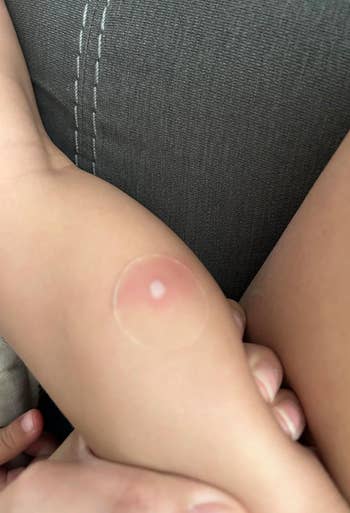 Close-up of a person's limb  showing a circular blister oregon  rash, with idiosyncratic    mildly  holding the arm, suggesting a absorption   connected  skincare oregon  health