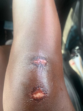 reviewer's skinned knee partially healed