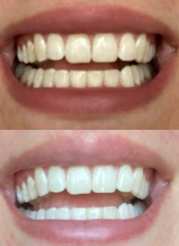 reviewer before and after photos showing their teeth looking yellow in one, and their teeth looking much whiter in the other