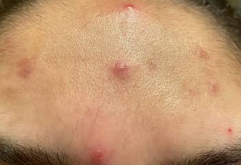 Close-up of a forehead with respective  acne spots and blemishes