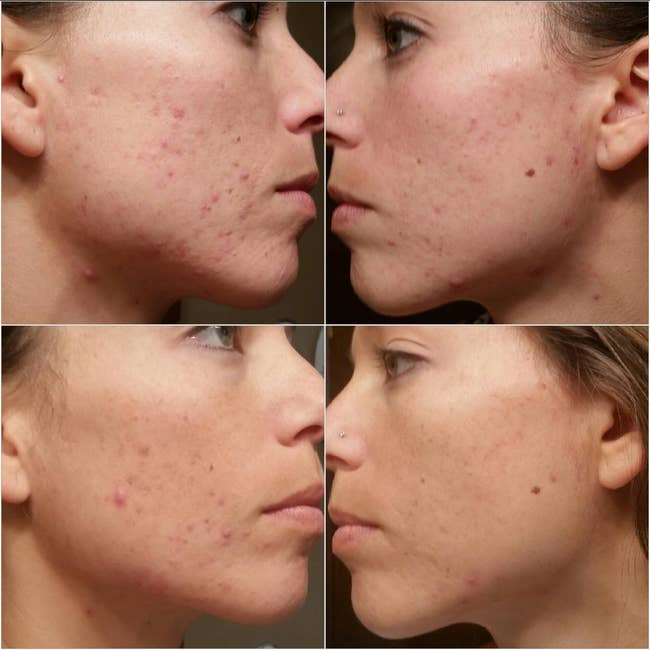Close-up of a person's look   successful  4  images, showing acne and tegument  changes from antithetic  angles