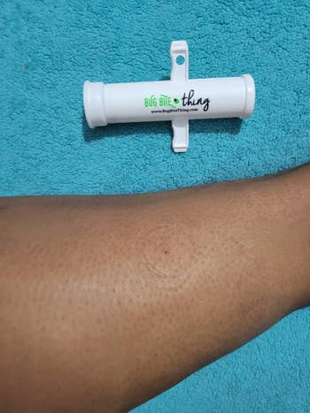Writer's photo of the Bug Bite Thing next to where she used it on her leg