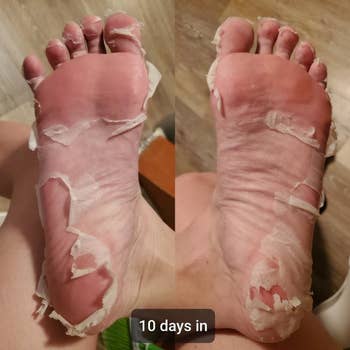 the same reviewer's photo of their peeling skin 10 days after using the foot mask