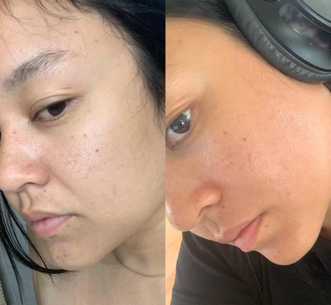 before and after images of a reviewer with clogged pores and acne that are all then cleared up