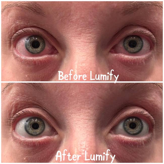 Close-up of eyes, top showing redness before using Lumify, bottom showing whitened eyes after Lumify