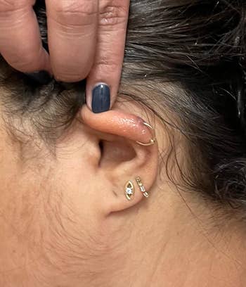  photo of same piercing fully healed after using solution 