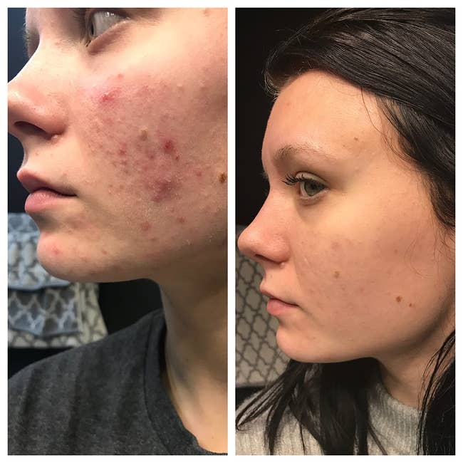 Reviewer showing their skin before and after with less severe acne after using the wash