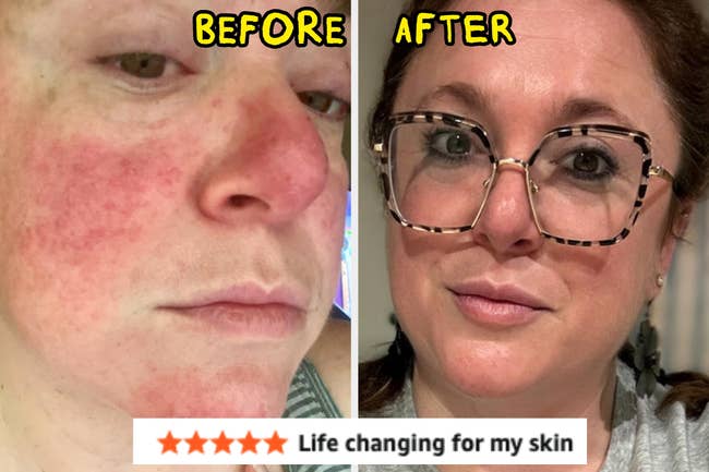 Side-by-side earlier  and aft  of a person's look   with improved tegument  condition, featuring a merchandise  reappraisal  standing  of 5  stars