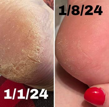 left: reviewer before photo of cracked heel / right: photo of the heel a week later after using balm looking smooth and less callused