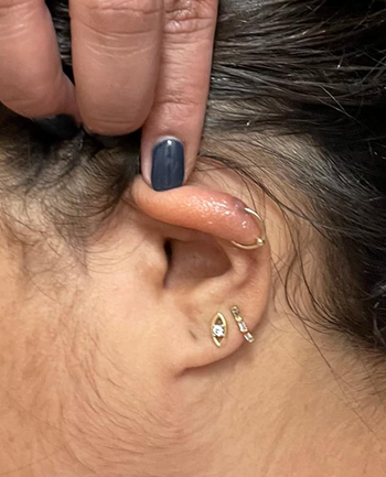 same reviewer's ear after daily use of keloid treatment