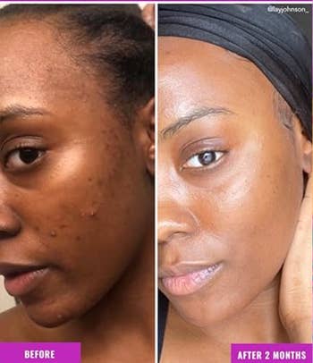 Side-by-side examination  of a woman's tegument  earlier  and aft  utilizing skincare, showing reduced blemishes and smoother complexion aft  2  months