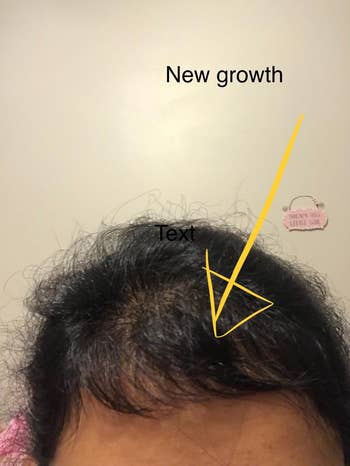 reviewer showing the new hair growth from using the massager