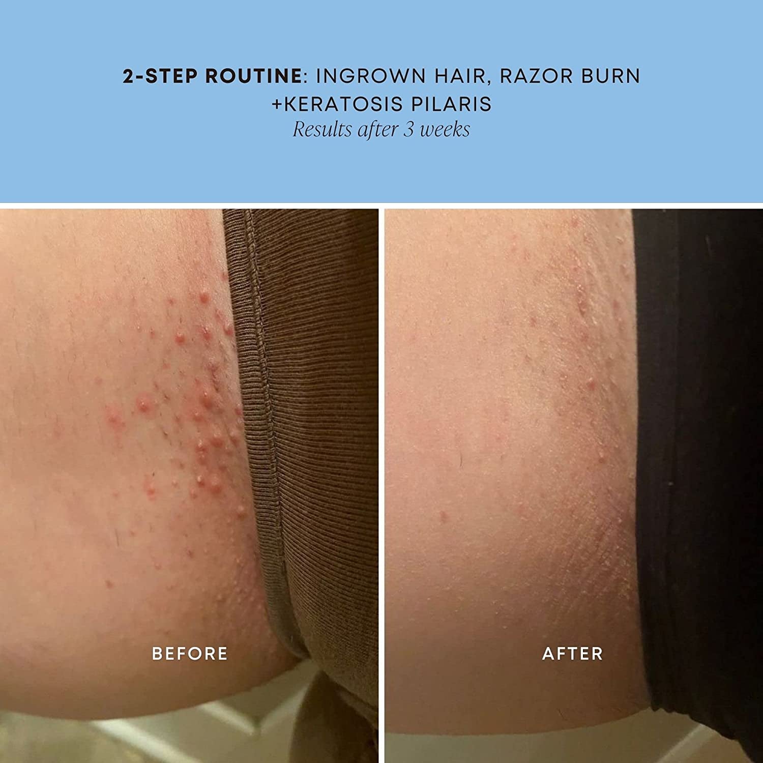 model skin before and after using oil with red bumps before and bumps gone after using two step routine for three weeks
