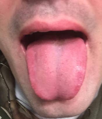 The same reviewer's tongue not yellow anymore after using the scraper