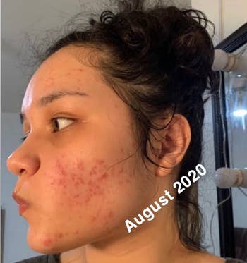 reviewers skin before using exfoliant with redn ess and acne