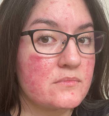 reviewer with acne before using face wash