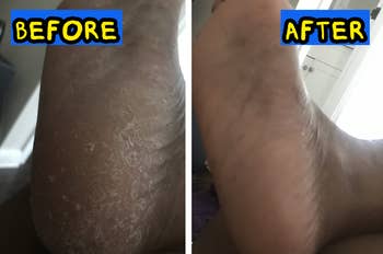 Before and aft representation of a ft showing improved tegument condition; antecedently adust and cracked, present creaseless and moisturized