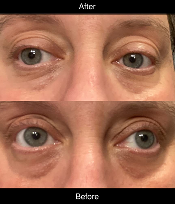 another reviewer showing their eyes before using the masks and after with a visible reduction in puffiness