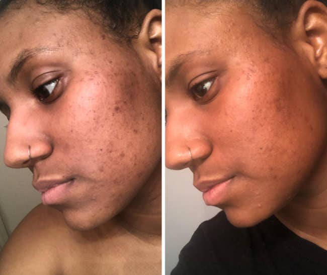 on left, reviewer's cheek with dark spots and some acne. on right, same reviewer's cheek with faded dark spots and less acne after using the exfoliant above