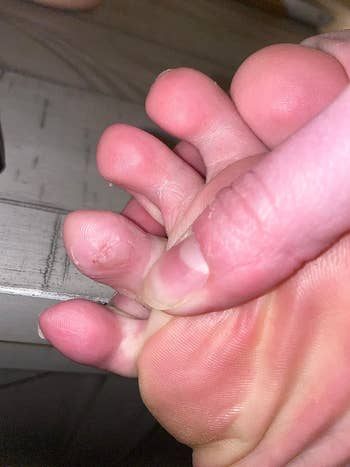 Gambar close-up setelah jari kaki yang sama sembuh