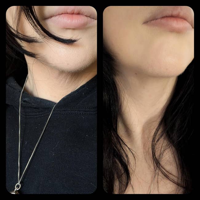 Side-by-side examination of a person's chin and cervix area, earlier and aft utilizing a grooming product
