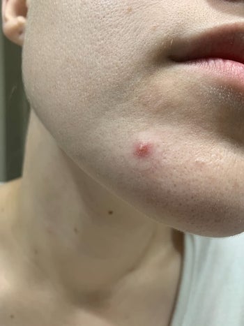 Reviewer's chin with a large pimple and a pimple patch on top