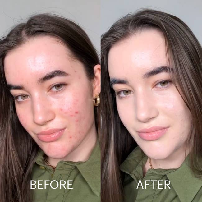 before-and-after of model with acne on left and same model with clearer skin on right after using the color-correcting treatment