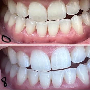 Before and aft images amusement teeth whitening results, highlighting a noticeable betterment successful bony brightness and appearance