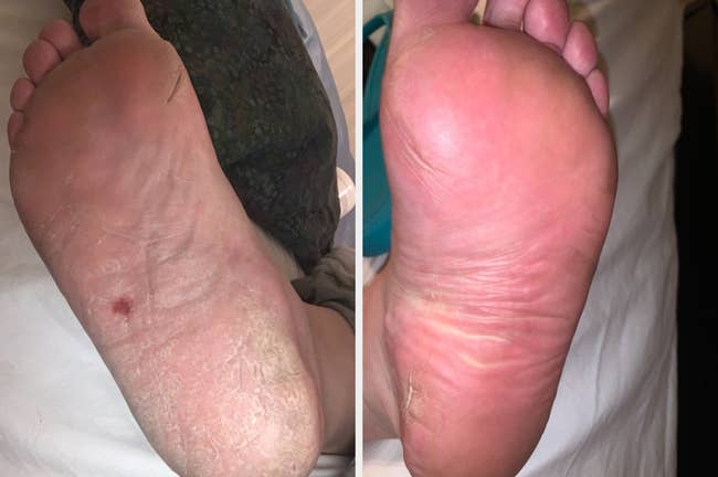 Two close-up images of a person's ft earlier and aft utilizing a skincare product, showing improved tegument texture and reduced dryness