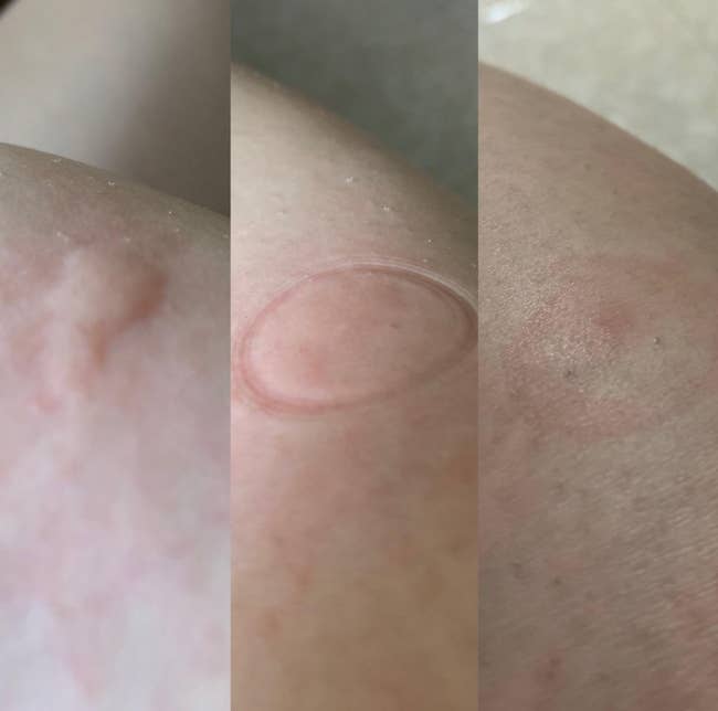 A before, during, and after photo of a bug bite going down since using the suction tool