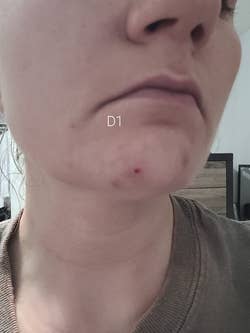 Reviewer on day one of using Rescue Balm, with picked, irritated, and slightly bloody blemishes
