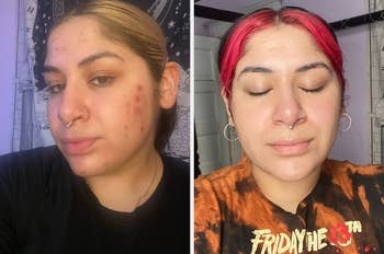 Person showing before and after skincare results, with noticeable improvement in the after photo