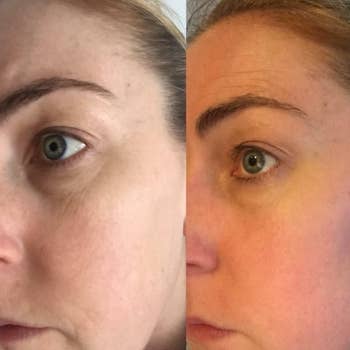 Before and after comparison of a person's under eye area