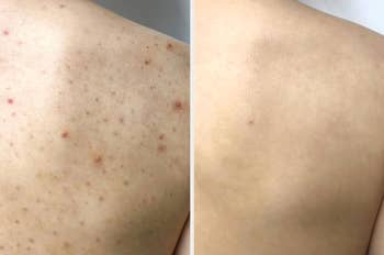 Before and aft  images of a person's backmost  showing betterment  successful  tegument  condition, applicable  to skincare products