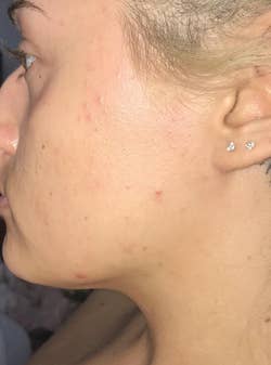 reviewer's face with peach fuzz removed and skin looking smoother