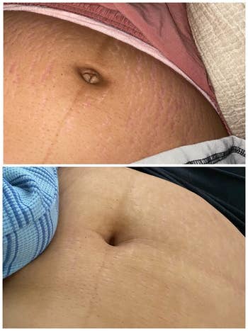 top to bottom: stomach with stretch marks and same stomach with gradually fading stretch marks after using bio-oil