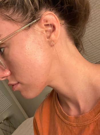 same reviewer with acne gone after using product