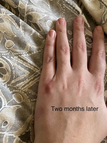 image of reviewer's hand two months later completely healed