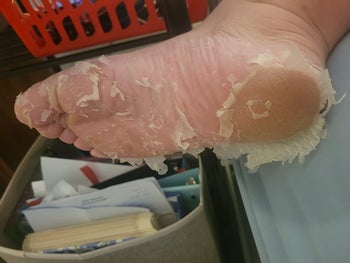 Tons of dry skin peeling off reviewer's foot after using the mask