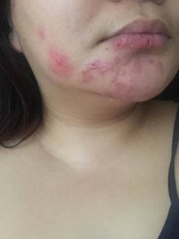 reviewer before photo showing red acne scarring on their face