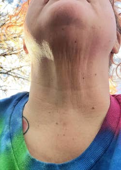 Reviewer's neck before using gold bond cream