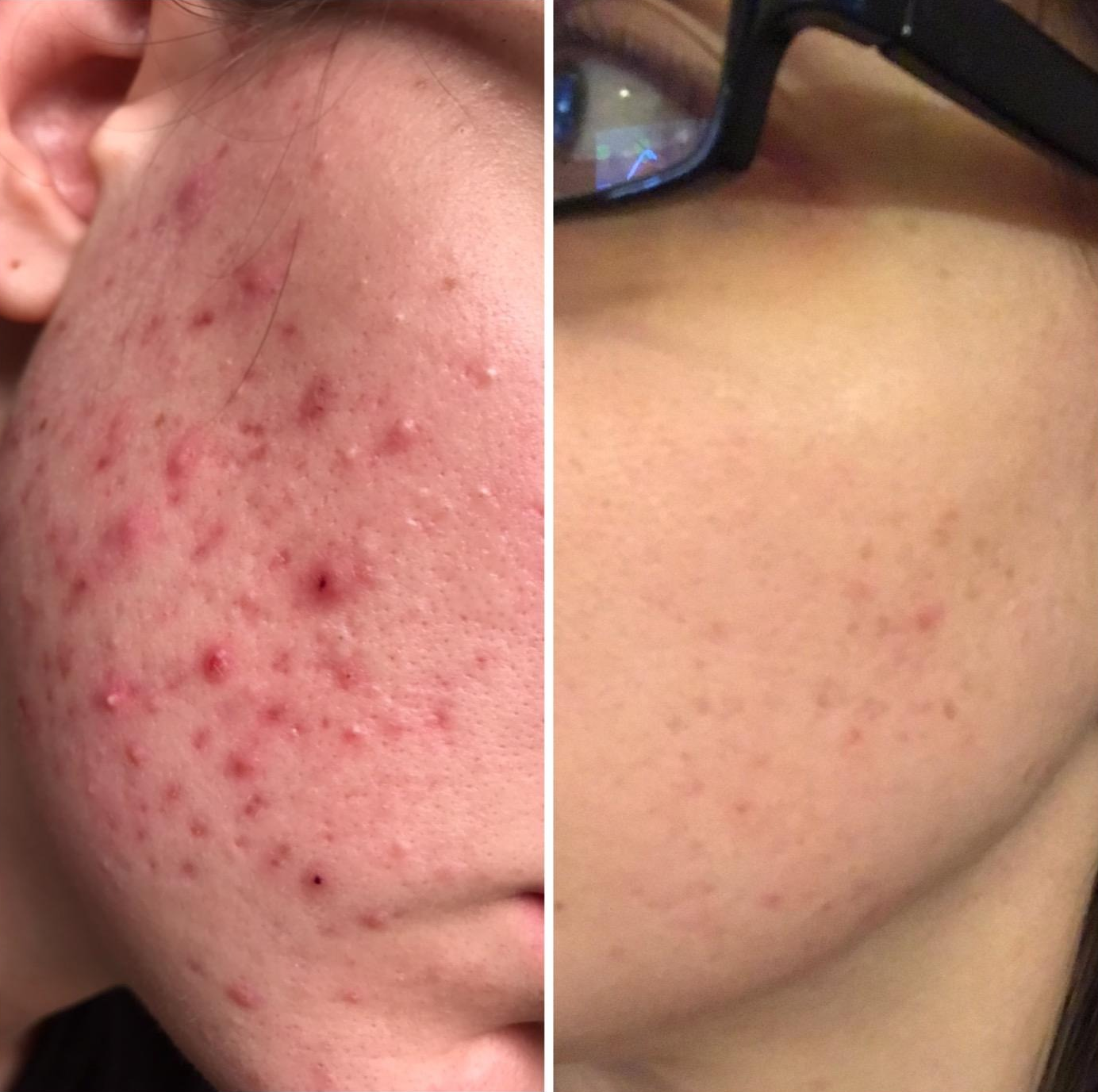 26 Skincare Products For Acne Reviewers