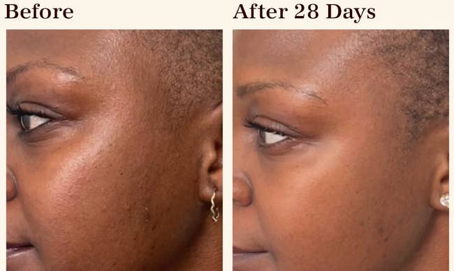 Before image of a model with hyperpigmentation/After results showing less hyperpigmentation