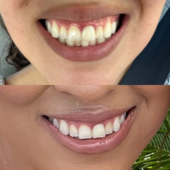 Before and aft photos showing dental translation with improved alignment and whitening