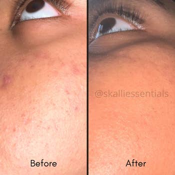 A before and after of someone with hyperpigmentation before using product, and noticeably clearer, brighter skin after using the product