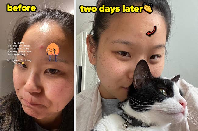 a reviewers before/after two days after using the pimple patch