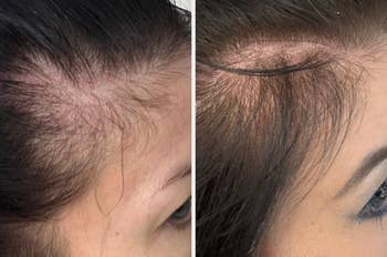 Sebelum dan sesudah gambar yang menunjukkan peningkatan yang nyata dalam kepadatan rambut pada kulit kepala seseorang, menyoroti efektivitas produk