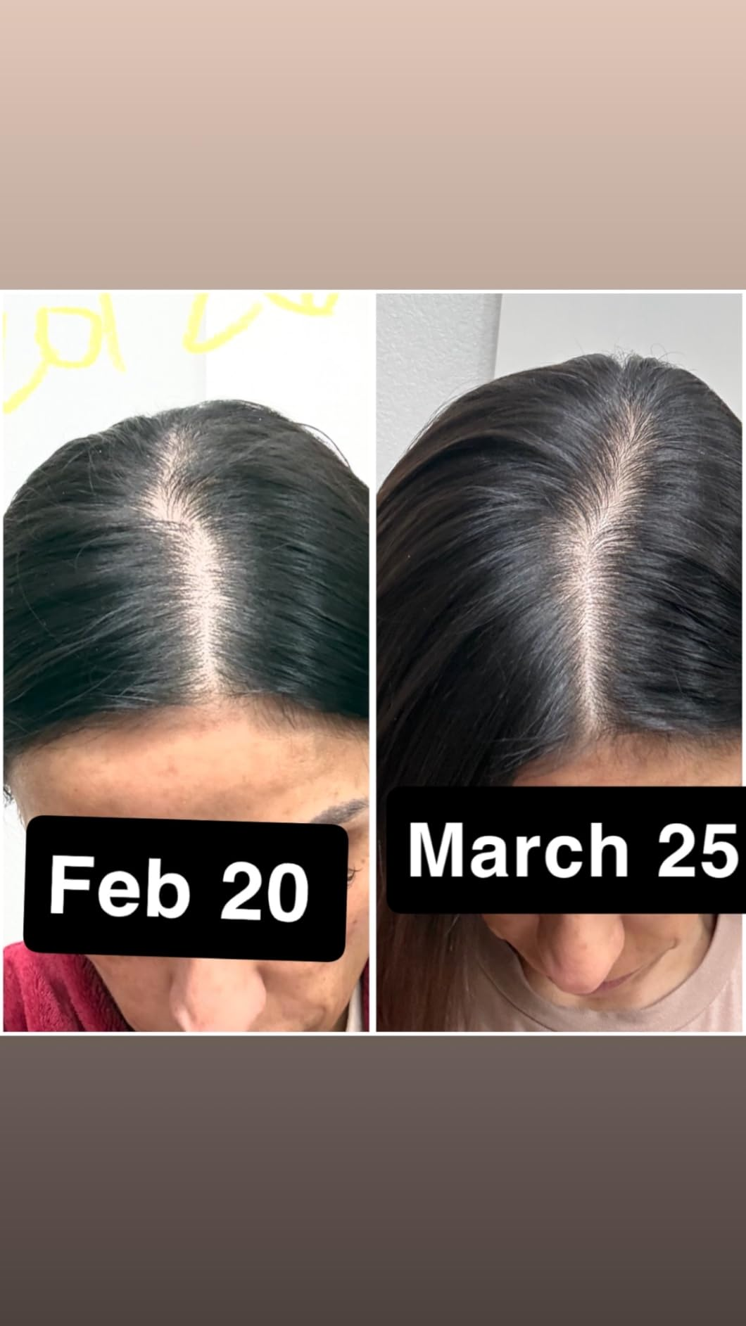Side-by-side examination  of a person's hairsbreadth  growth, showing a disposable   betterment  from February 20 to March 25